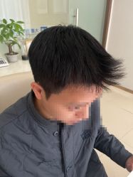 -大麦微针植发丨全国连锁