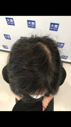 -大麦微针植发全国连锁