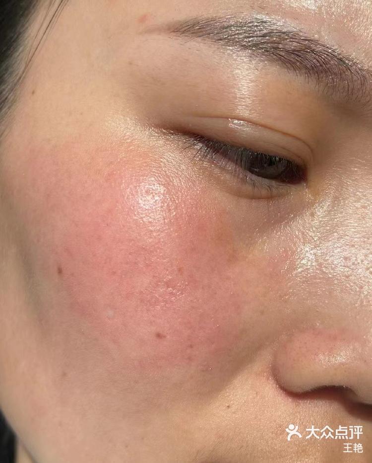 泛红发烫的脸舒服了谢谢老闺蜜推荐