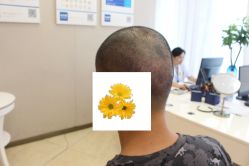 -大麦微针植发丨全国连锁