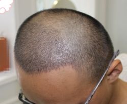 -大麦微针植发丨全国连锁