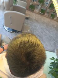 -碧莲盛·不剃发植发