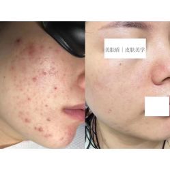 -美肤盾祛痘·问题肌头疗管理中心