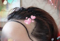 -大麦微针植发全国连锁