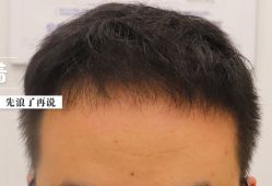 -大麦微针植发全国连锁