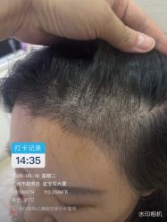 点击看大图 -大麦微针植发全国连锁