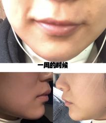 体验后-西安壹加壹医疗美容·西北抗衰旗舰店