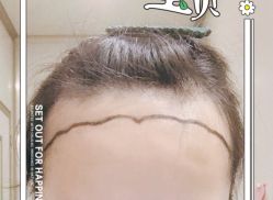 -大麦微针植发全国连锁