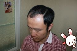 -大麦微针植发丨全国连锁