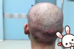 点击看大图 -大麦微针植发丨全国连锁