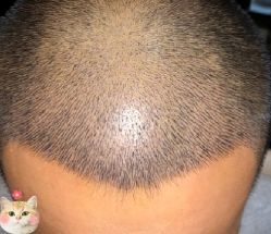 -大麦微针植发丨全国连锁