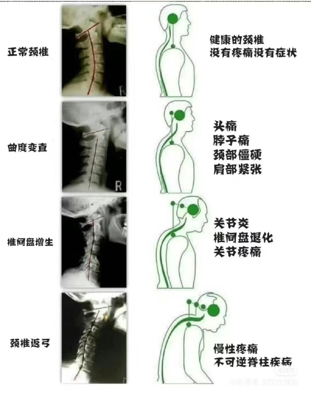 颈椎前凸消失图片