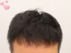 -大麦微针植发全国连锁