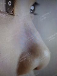 点击看大图 体验后-悦己医疗美容整形线雕提升专门店