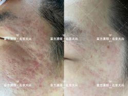 -苗方清颜痘肌研究所