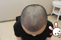 -大麦微针植发丨全国连锁