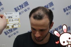 点击看大图 -大麦微针植发丨全国连锁