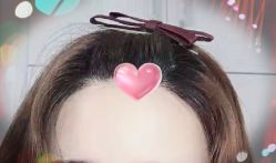 -大麦微针植发全国连锁