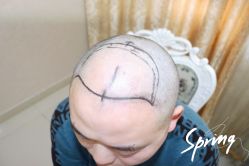 点击看大图 体验后-大麦微针植发全国连锁