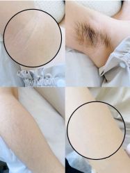 点击看大图 -小梨·OndaPro·专业脱毛连锁机构