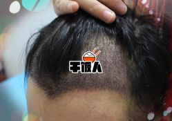 -大麦微针植发全国连锁