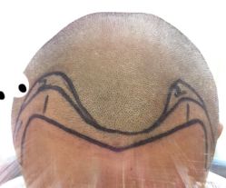 -大麦微针植发全国连锁