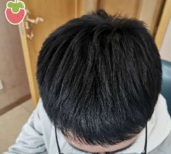 -大麦微针植发丨全国连锁