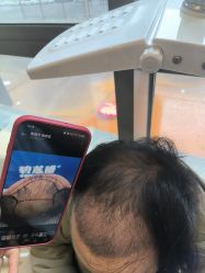 -碧莲盛·不剃发植发