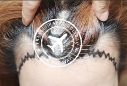 -大麦微针植发全国连锁