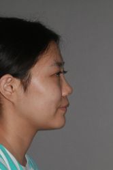 体验前-北京米扬丽格医疗美容·联合丽格鼻整形中心