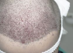 -大麦微针植发丨全国连锁