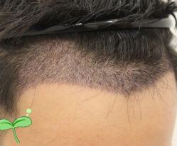 -大麦微针植发丨全国连锁