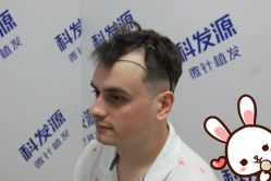 点击看大图 -大麦微针植发丨全国连锁