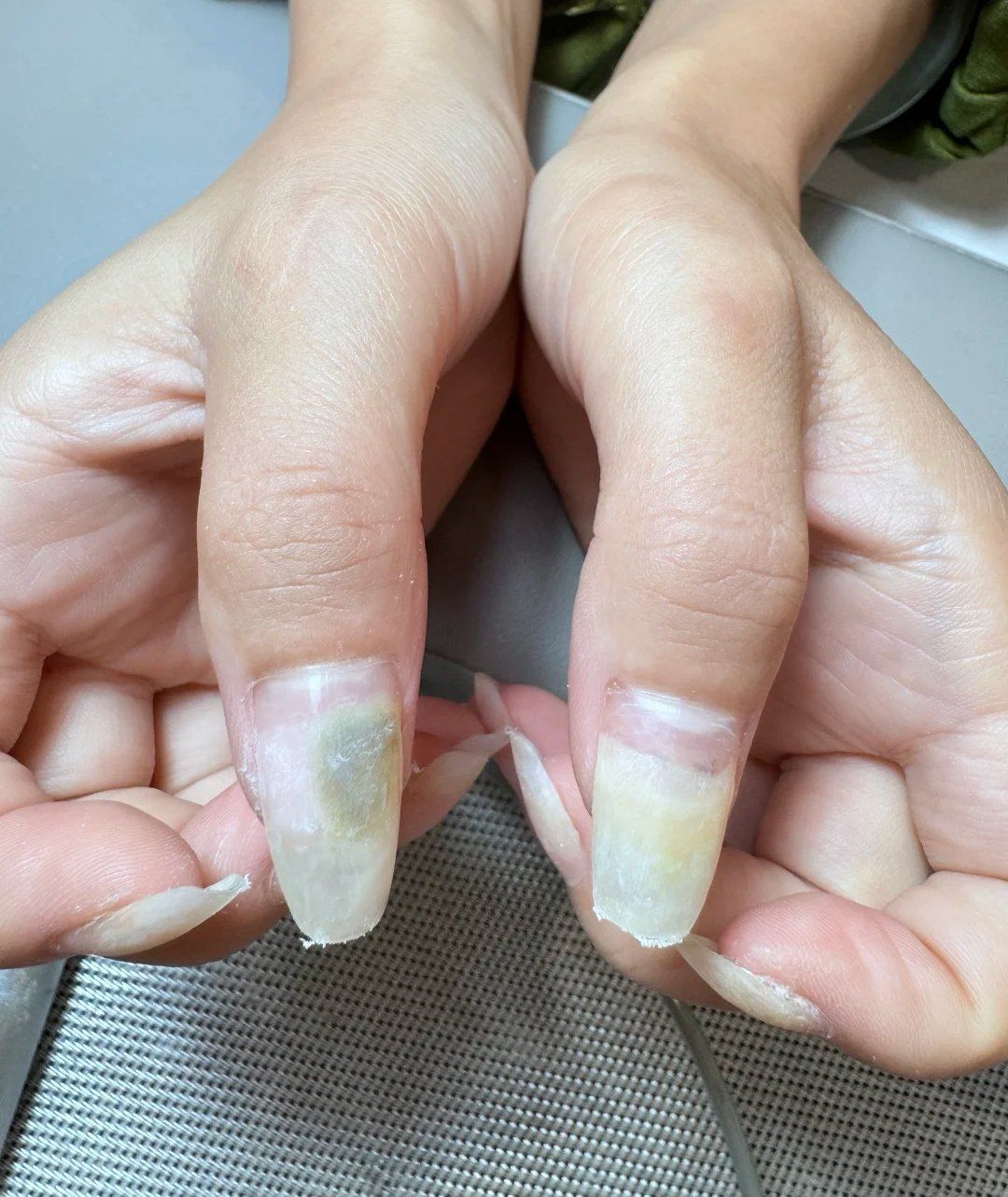 看到网上这些没其他人分享的绿脓杆菌指甲照片太吓人了#我的美甲新