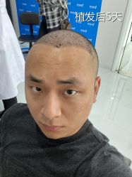 -雍禾植发全国连锁