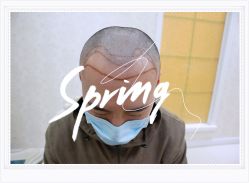 体验后-大麦微针植发全国连锁