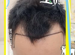 -大麦微针植发全国连锁