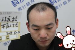 点击看大图 -大麦微针植发丨全国连锁