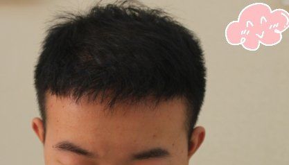 -大麦微针植发丨全国连锁