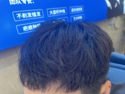 -碧莲盛·不剃发植发