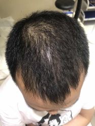 点击看大图 -大麦微针植发全国连锁