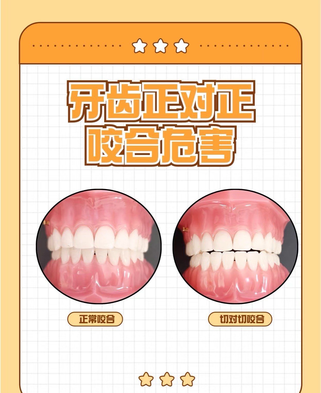 n我们正常牙齿咬合不管是前牙,还是后牙,都有一个正常的覆颌覆盖