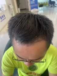 体验后-大麦微针植发全国连锁
