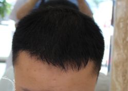 -大麦微针植发丨全国连锁