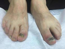 -德哥灰指甲脚气甲沟炎跖疣护理