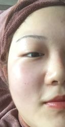 体验后-杭州整形医院·国际部