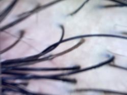 体验前-雍禾植发全国连锁