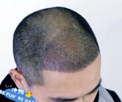 -大麦微针植发丨全国连锁