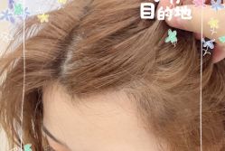 -大麦微针植发全国连锁