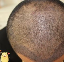 -大麦微针植发丨全国连锁